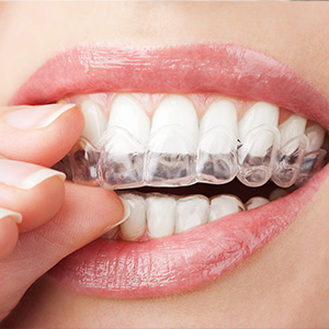 Dental Implants Dentist in Slidell